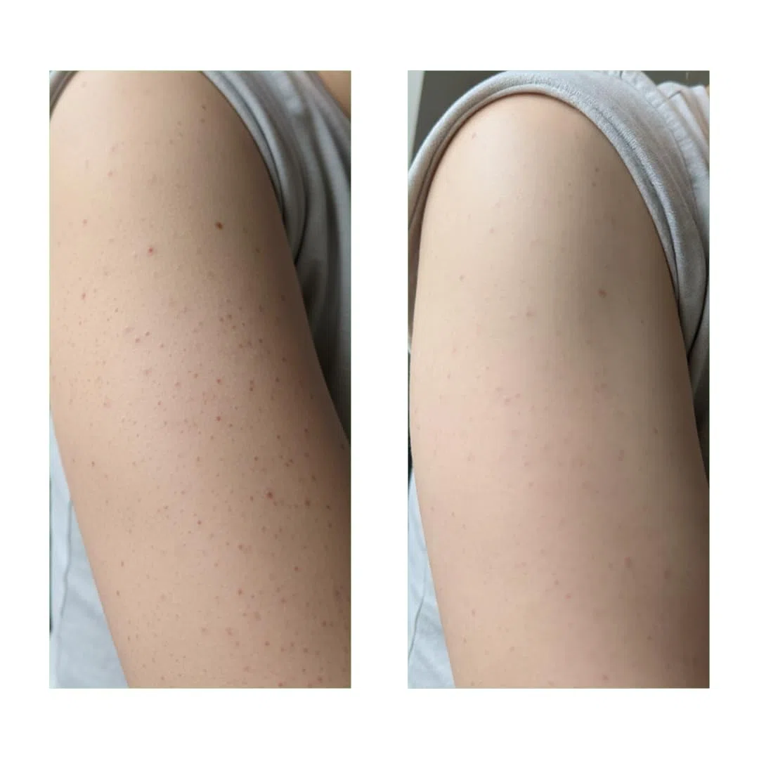 Keratosis Pilaris Set gegen Erdbeerhaut Anti Reibeisenhaut Bundle