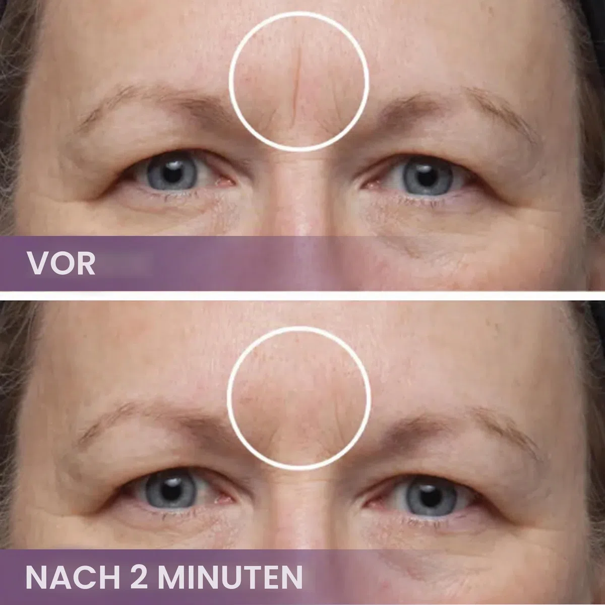 Dermaflage Narben Make-up Concealer, Aknennarben Filler, Narben Abdeckung, 1 Monatsvorrat