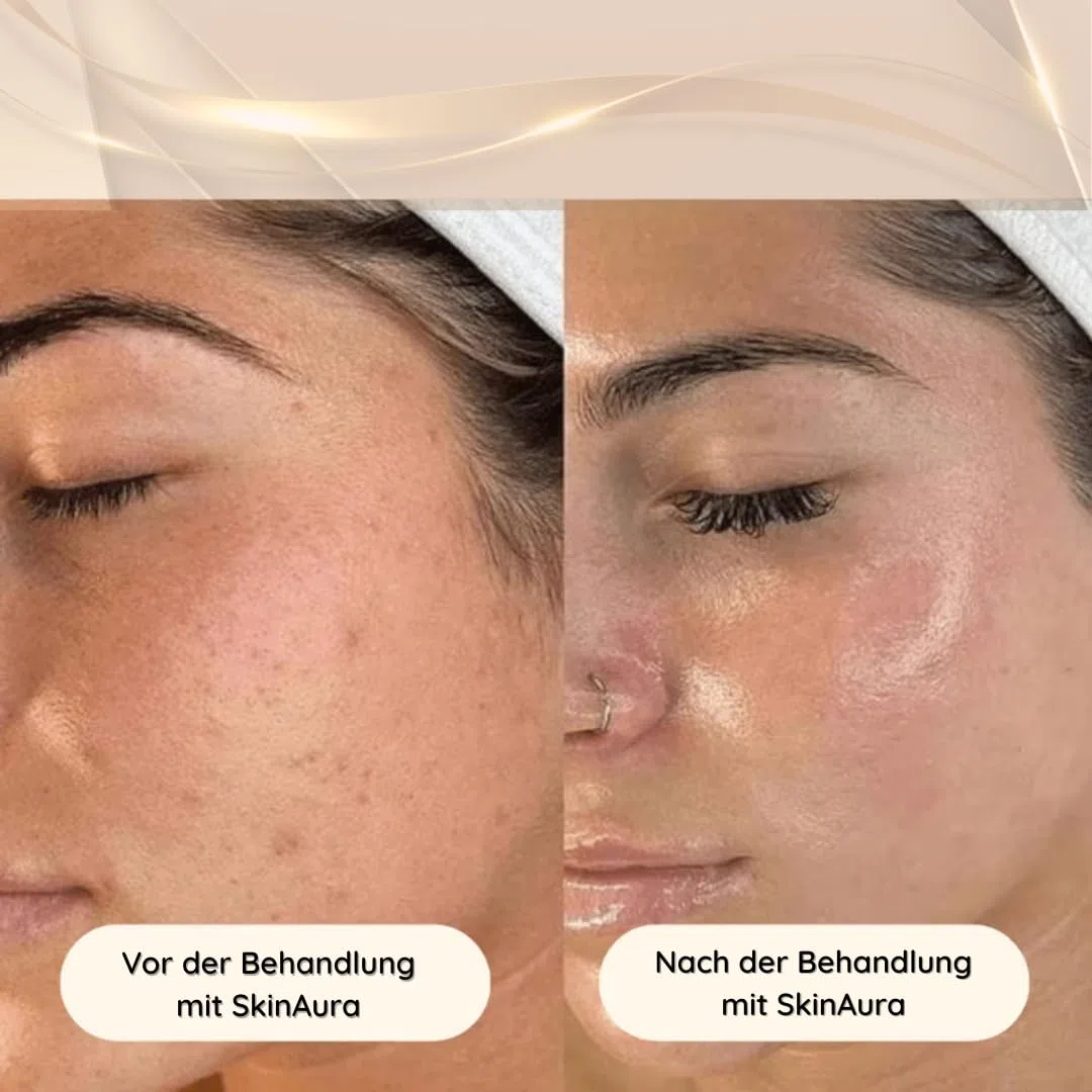 SkinAura Hochfrequenzstab Gesicht, Haare & Body mit 6 Elektroden | Akne, Faltenreduktion, Anti-Aging, Haarpflege | Gesichtsmassagegerät, HF Stab, Darsonval | Vielseitige Aufsätze für Gesicht, Kopfhaut & Körper