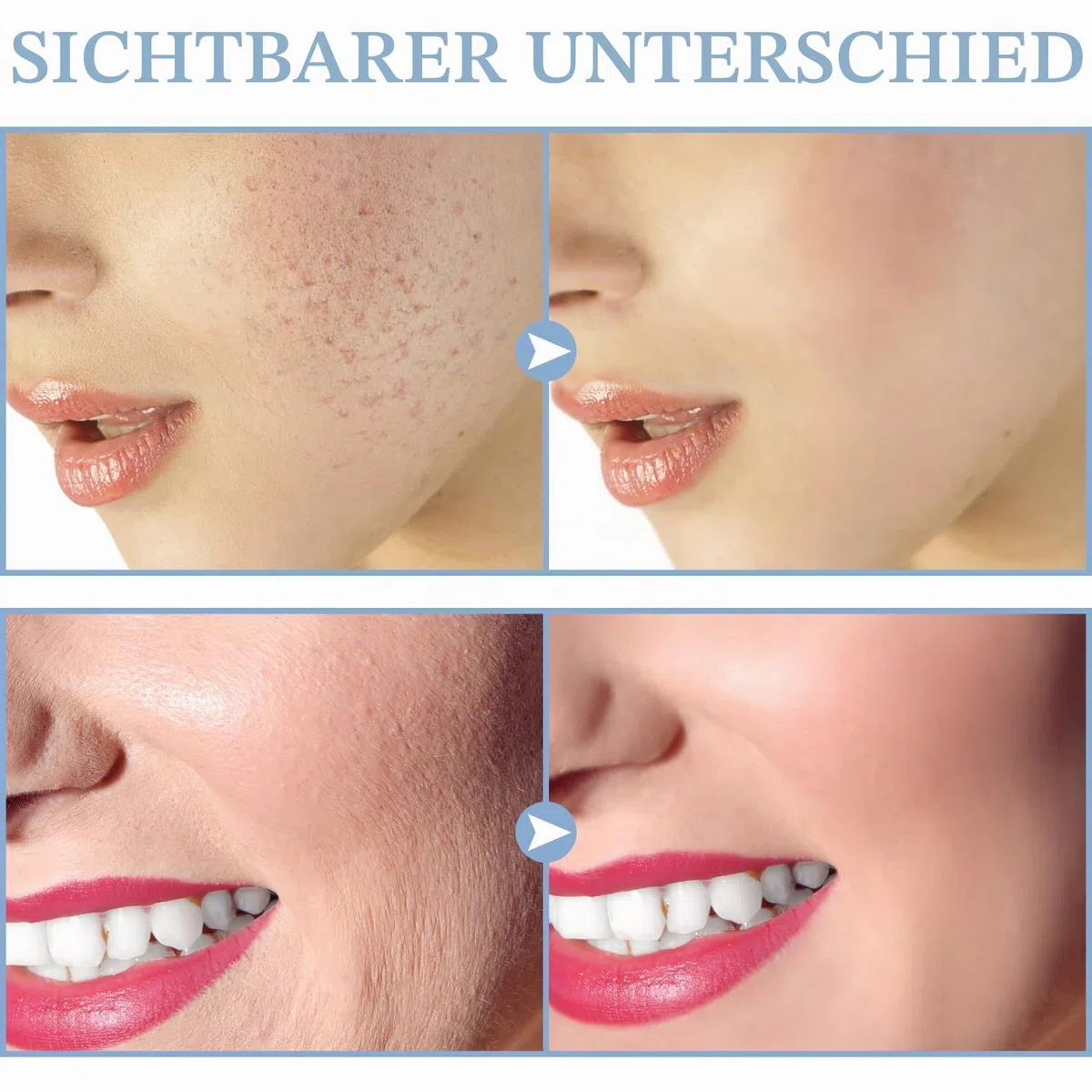 TUMAKOU Hochfrequenzstab Gesicht Hauttherapiegerät mit 4 Neon Stab Aknebehandlung Hautstraffung Faltenreduzierung
