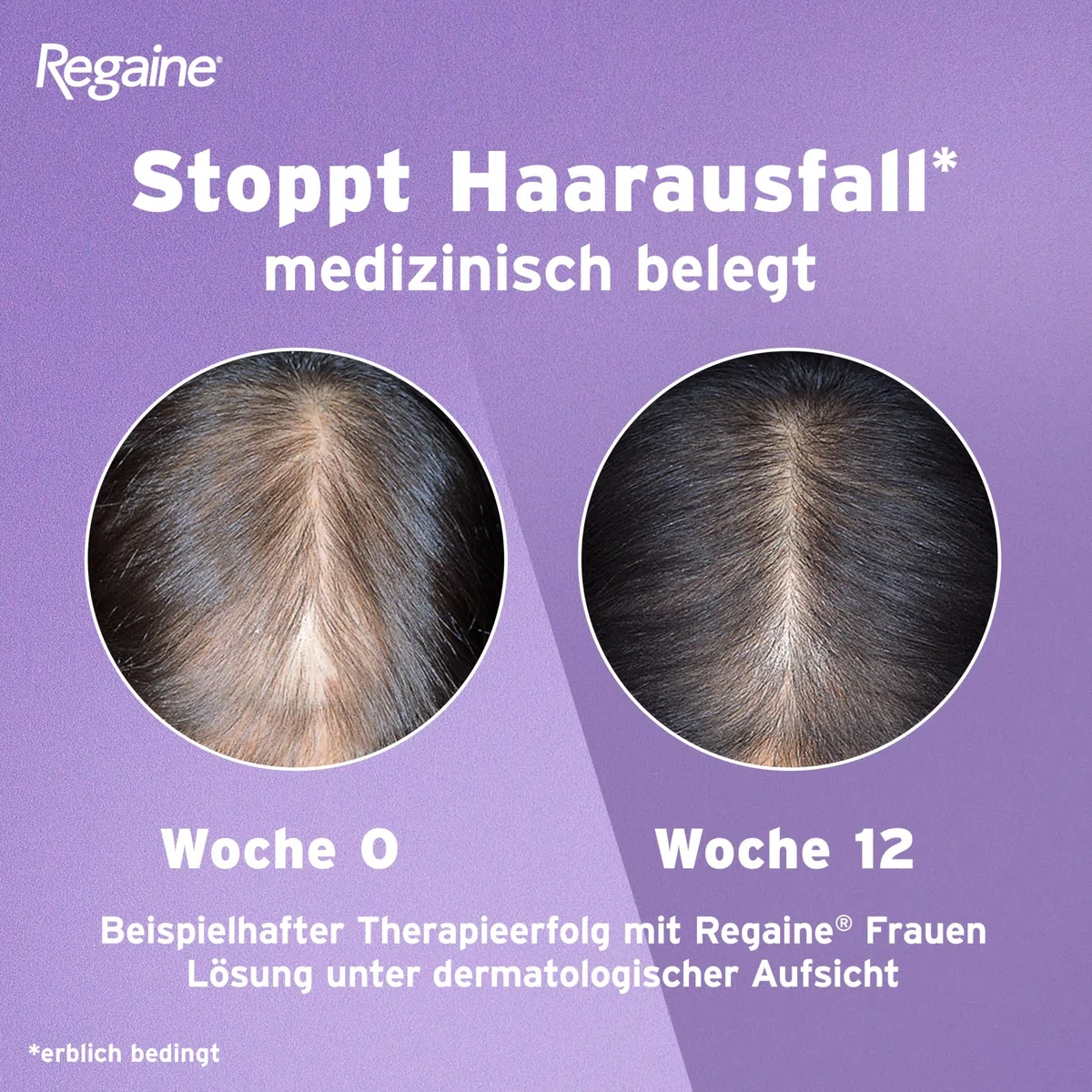 REGAINE Frauen Lösung: Mit 20 mg/ml Minoxidil bei erblich bedingtem Haarausfall, stoppt den erblich bedingten Haarausfall und regt neues Haarwachstum an, 6-Monats-Vorrat, 6 x 60 ml
