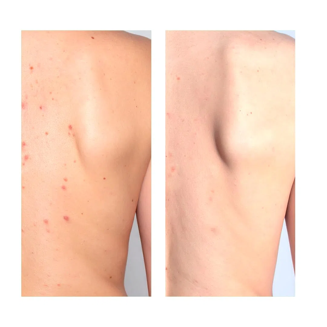 Anti Pickel Körperpflege Set mit Salicylsäure 3 Produkte Bundle