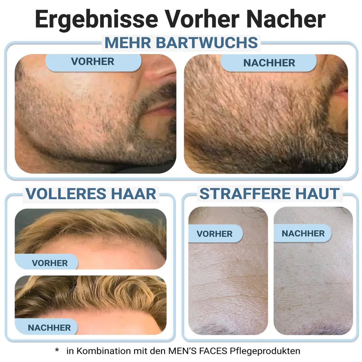 Bartroller 192 ECHTE Nadeln Dermaroller 0,5mm für Männer Bartwuchs & Haarwachstum beschleunigen