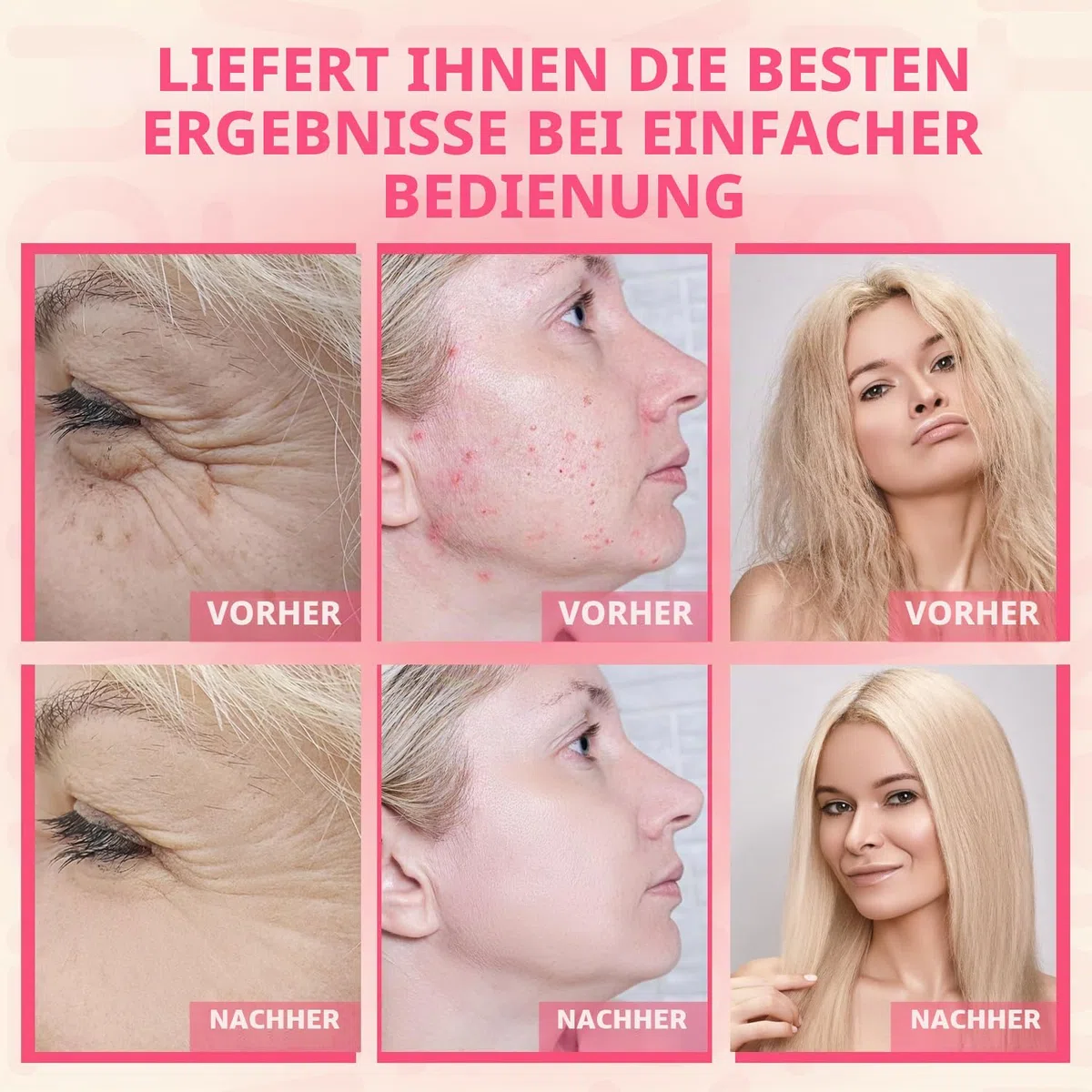 TUMAKOU Hochfrequenzstab Gesicht - Hochfrequenz Gerät mit 4 Stab
