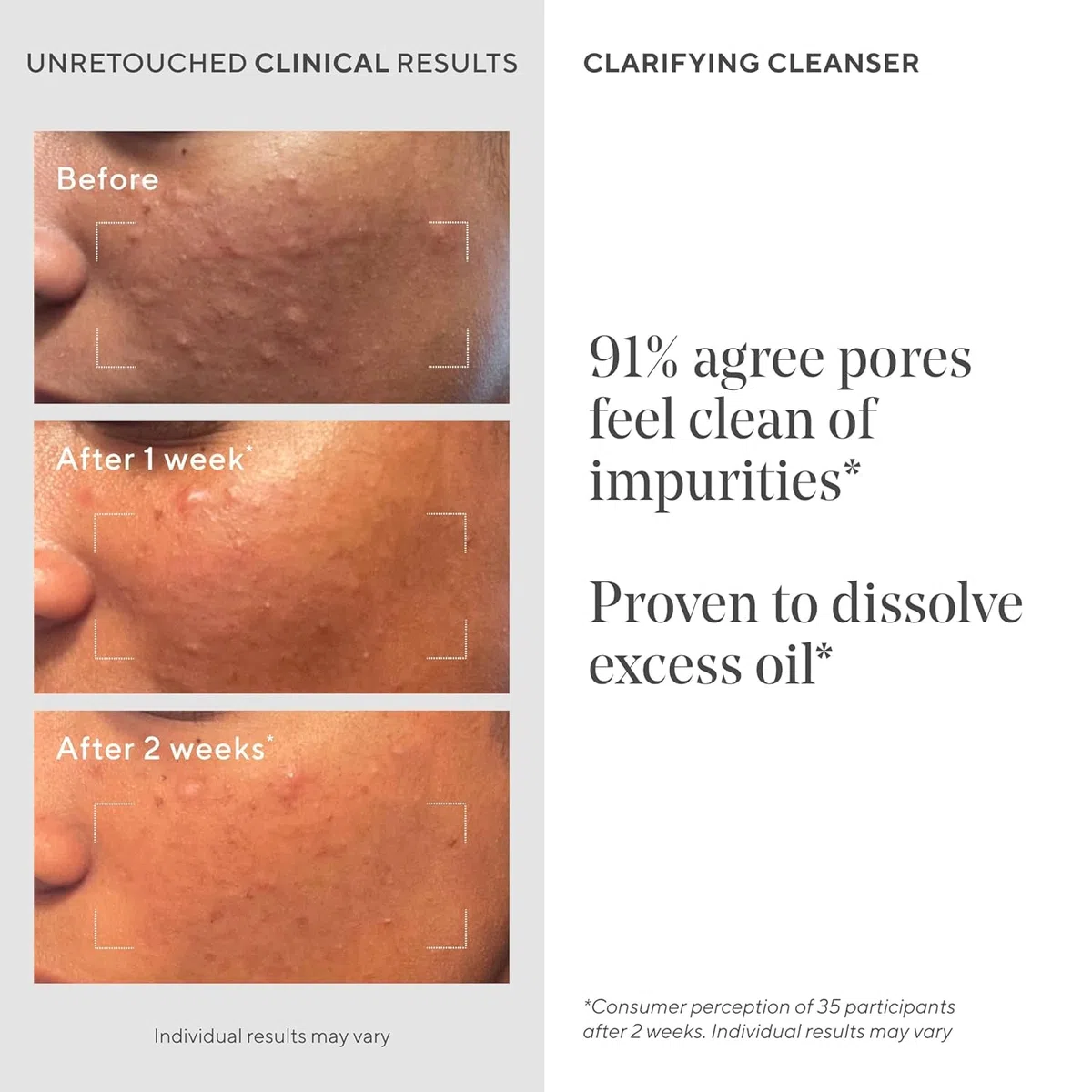 Murad Blemish Control Cleanser – Mit Salicylsäure & Grüntee für klare, ausgeglichene Haut und weniger Unreinheiten