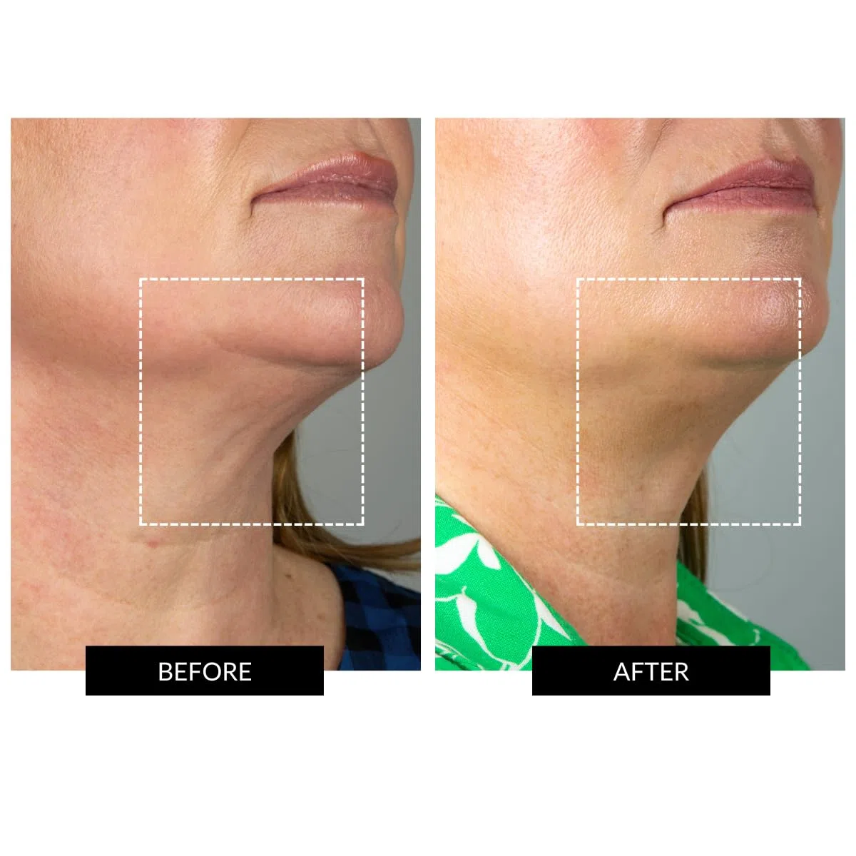 CurrentBody Haut-Radiofrequenzgerät | Gesichtstonungsgerät | Klinisch bewährte Technologie zur Hautstraffung und Anti-Aging