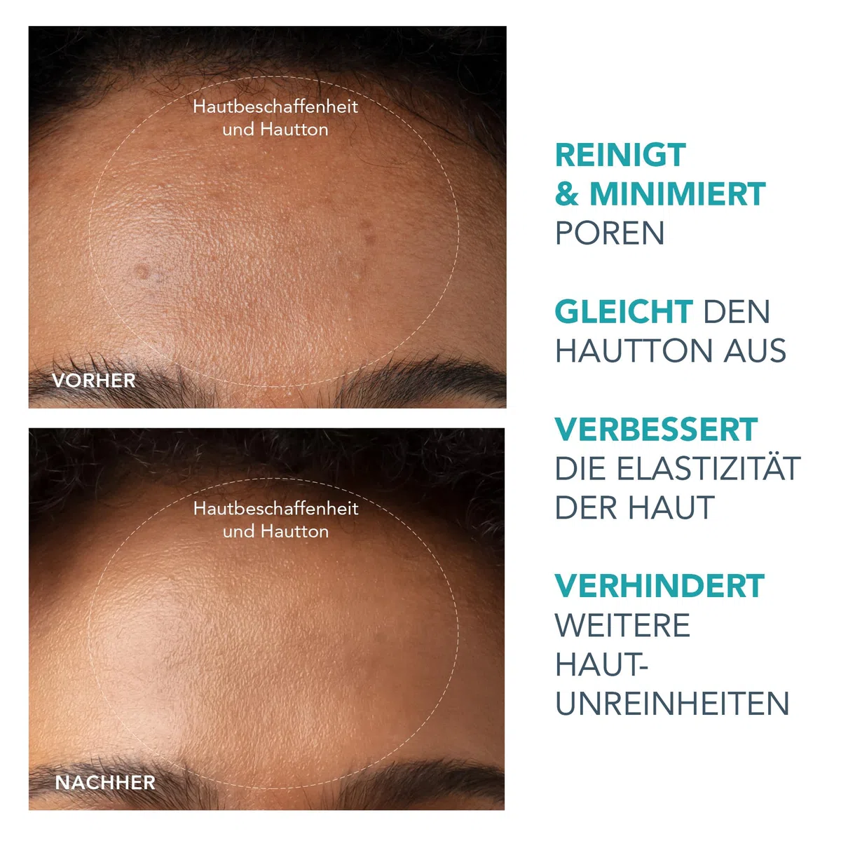 KIWI Mitesserentferner + KIWI Active Pore & Blackhead Mask 100 g Set | Mitesserentferner, Porensauger, Mitessersauger, Porenverfeinerer, Extraktor, Gesichtsmaske, Porenreiniger, Komedonen