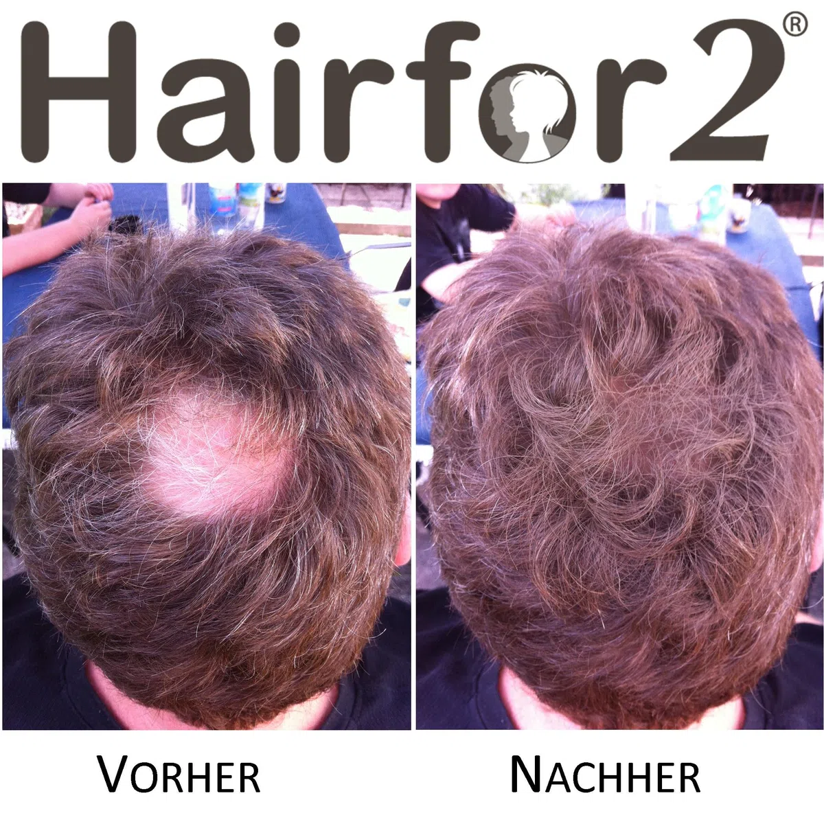 Hairfor2 Haarverdichtungsspray gegen lichtes Haar | Haarpuder | Streuhaar | Haarauffüller | Haarausfall | Haarverdichter (300ml, Mittelblond)