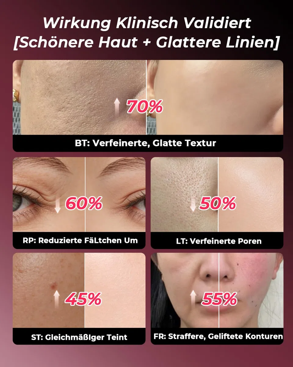Gesichtsmassagegerät Radiofrequenz 5-in-1, EMS & Lichttherapie, Straffendes Lifting für Gesicht & Hals, Reduziert Falten, Feine Linien & Vergrößerte Poren, Anti-Falten, für Straffere Haut (Roségold)